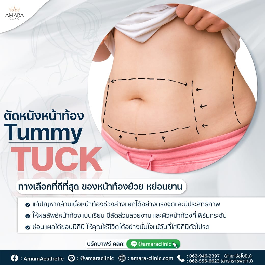 temp-20221117-Aware-single-Tummy Tuck-01